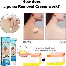 Lipoma removal cream applied to skin to reduce lumps and bumps.