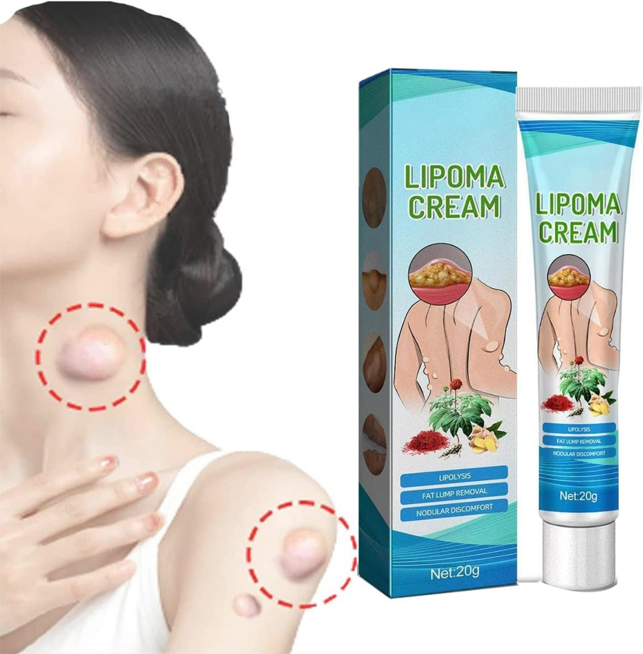 Minimizes chin and shoulder lumps with Lipoma Cream for fat reduction and nodular discomfort.