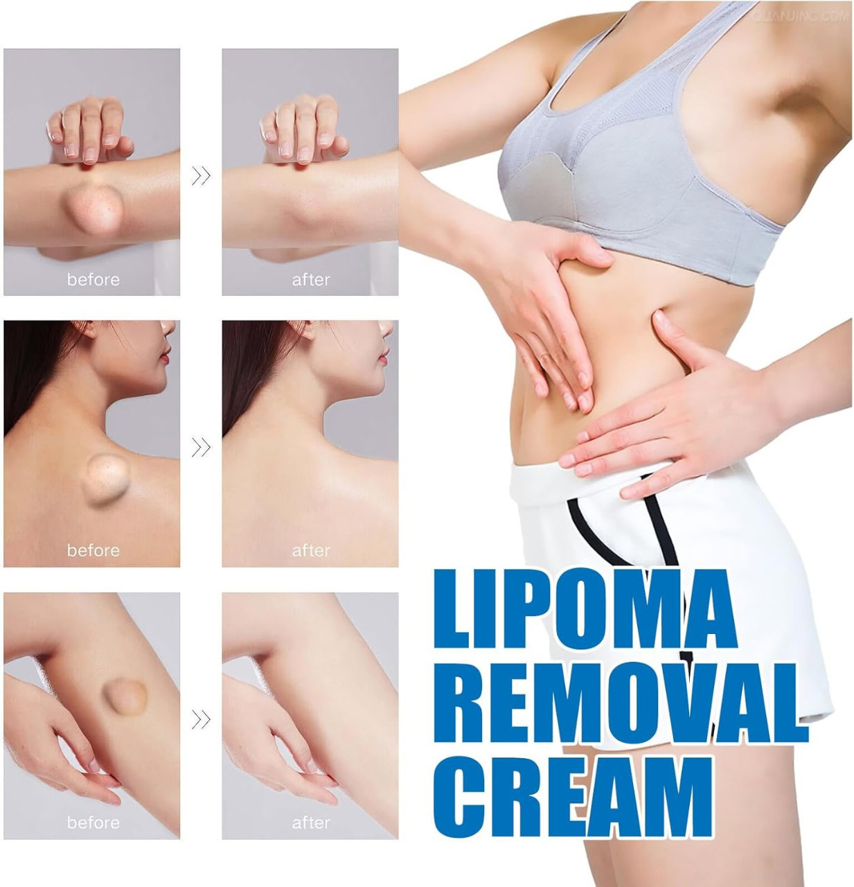 Reduces lipoma size, promotes skin firmness, non-invasive lipoma removal solution.